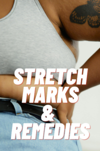 Stretch Marks Problem